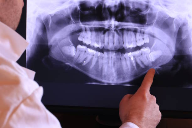 Best Emergency Tooth Extraction in Nanuet, NY